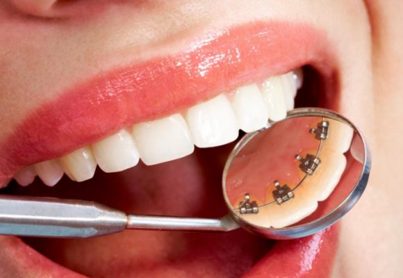 Ortodoncia lingual, una alternativa invisible
